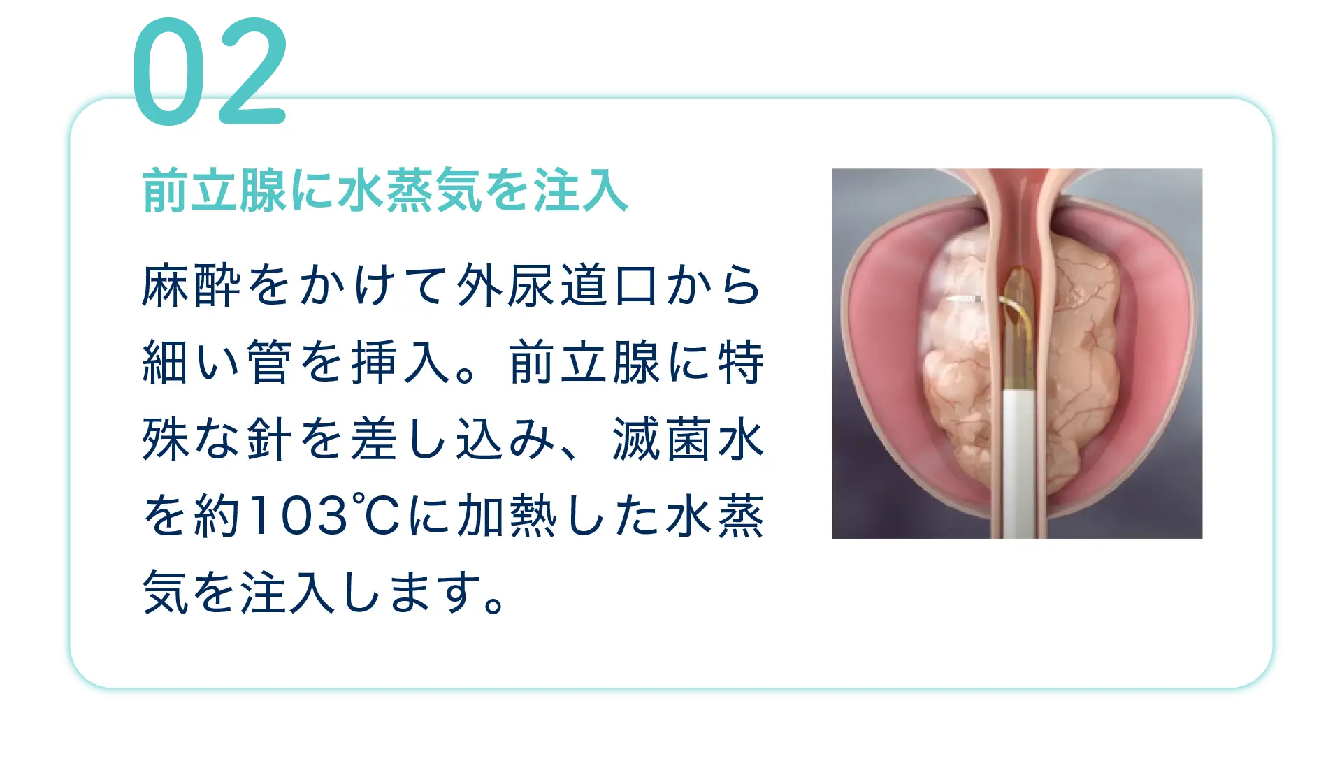 治療の流れ2 前立腺に水蒸気を注入