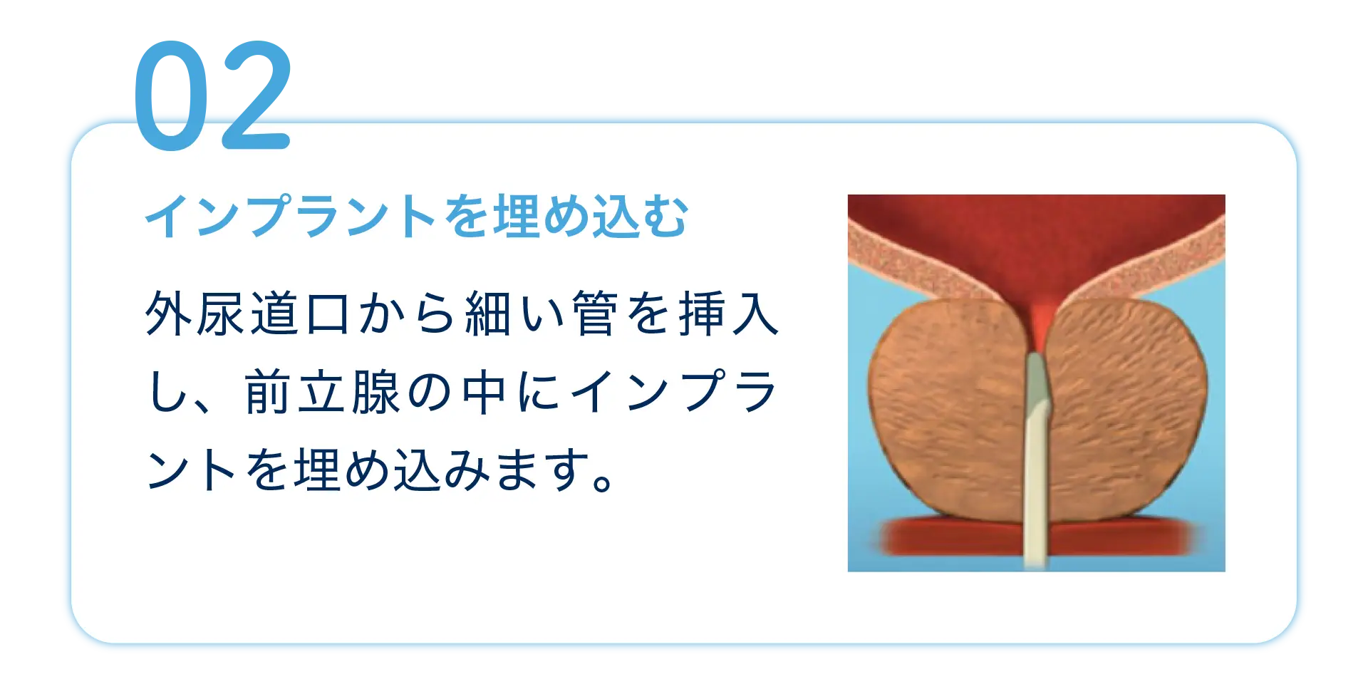 治療の流れ2 インプラントを埋め込む