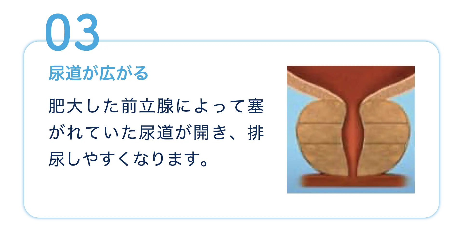 治療の流れ3 尿道が広がる